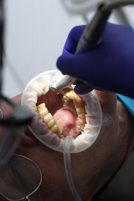 Jak probíhá bělení zubů: Co máte před začátkem ošetření vědět